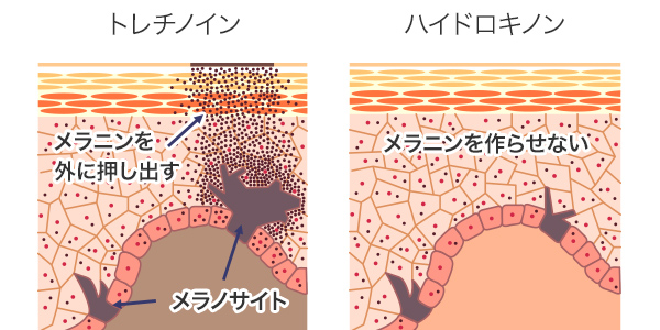 トレチノインとハイドロキノンの特徴