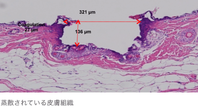 蒸散されている皮膚組織