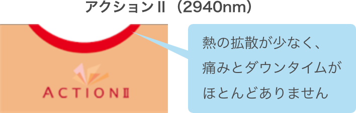 アクションⅡ(2940nm)熱の拡散が少なく、痛みとダウンタイムがほとんどありません。