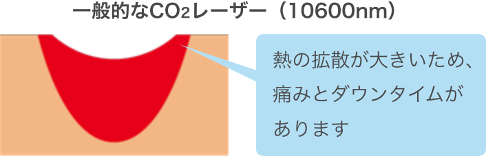 一般的なCO2レーザー（10600nm）熱の拡散が大きいため、痛みとダウンタイムがあります