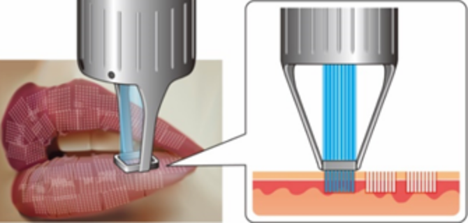 表皮を入れ替える唇レーザーにも対応