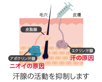 多汗症とは