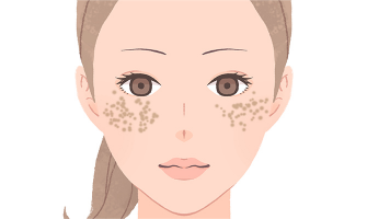 ADM（Aquired Dermal Melanocytosis/後天性メラノサイトーシス）