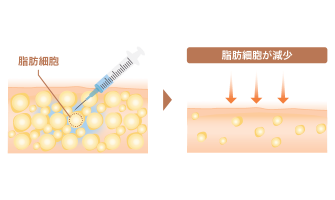 BNLS neo脂肪溶解注射 部分痩せ治療注射の特徴