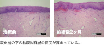 表皮層の下の粘膜固有層の密度が高まっている