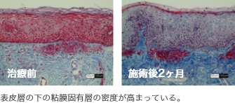 表皮層の下の粘膜固有層の密度が高まっている