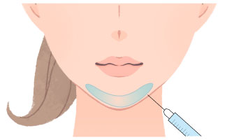 おとがい形成（ヒアルロン酸）