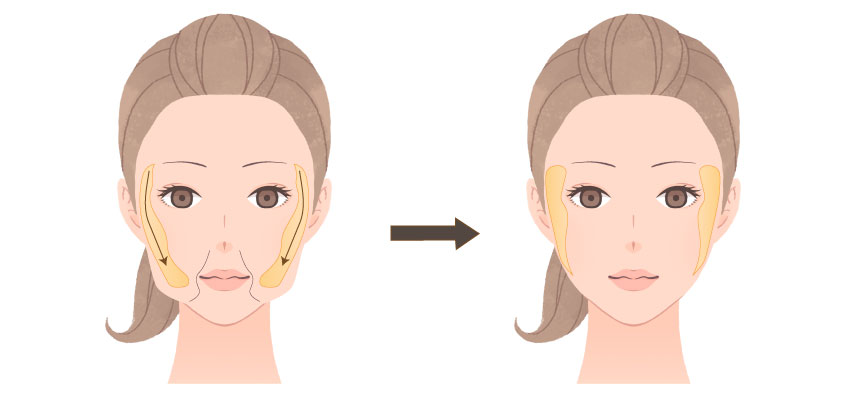 頬脂肪（バッカルファット）除去術
