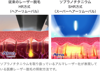 従来のレーザー脱毛（HR方式 ヘアーリムーバル）とソプラノアイス・プラチナム（SHR方式 スーパーヘアーリムーバル） ソプラノアイスプラチナムを取り扱っているアルマレーザー社が表現している医療レーザー脱毛の照射方法です。