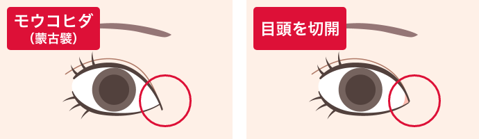 目頭・目尻の切開法とその特徴