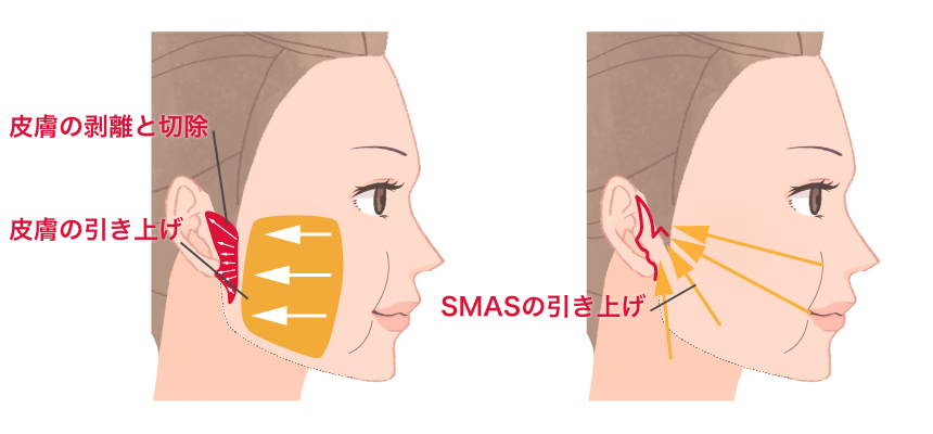 フェイスリフト(SMASリフト)手術の特徴