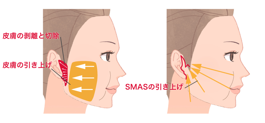 フェイスリフト（SMASリフト）手術の特徴