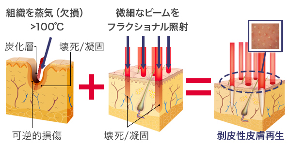 特徴2 麻酔も不要だから時間短縮