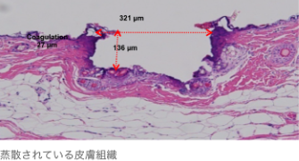 蒸散されている皮膚組織