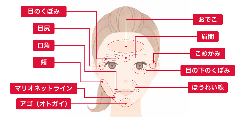 ヒアルロン酸注入シワ取り 適用部位 目のくぼみ、目尻、口角、頬、マリオネットライン、アゴ（オトガイ）、おでこ、眉間、こめかみ、目の下のくぼみ、ほうれい線