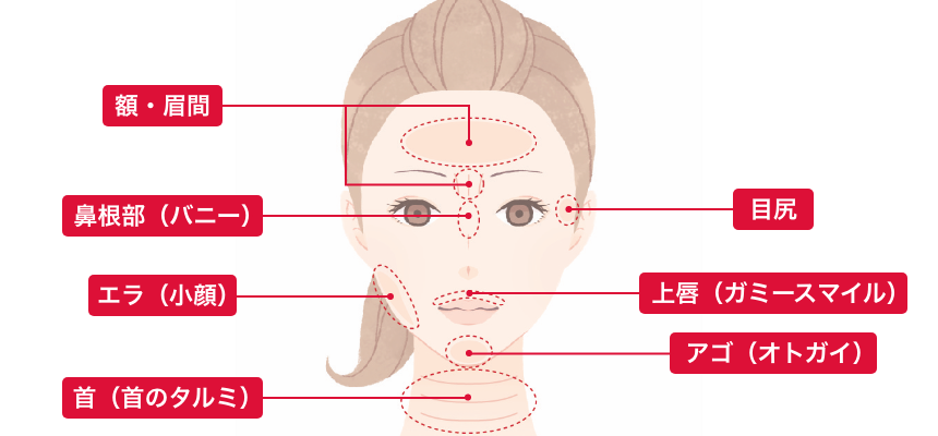 シワ取り注入 適用部位 額・眉間、鼻根部(バニー)、エラ(小顔)、首(キビのタルミ)、目尻、上唇(ガミースマイル)、アゴ(オトガイ)