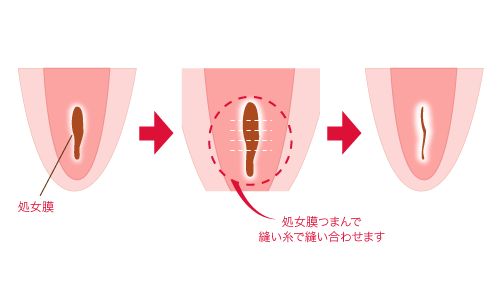 処女膜のお悩み