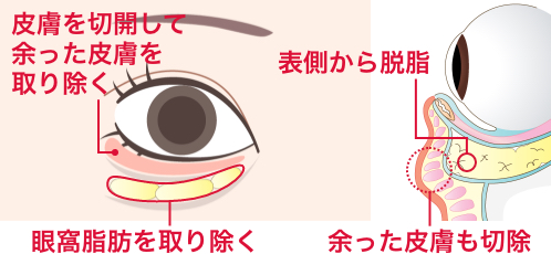 目の下のたるみ取り+脂肪取りで改善する方法