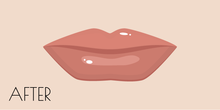 ユイメディカル幕張医院の唇レーザー シャイニングピール（古くなった角質を除去）の特徴