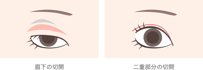 眉下の切開 二重部分の切開