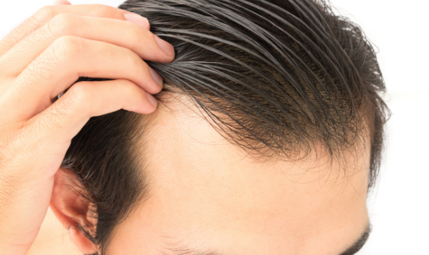 AGA（男性型脱毛症）薄毛の原因と種類、その治療方法