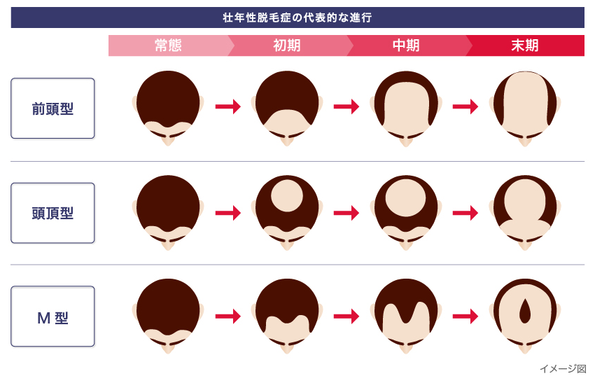 壮年生脱毛症の代表的な進行