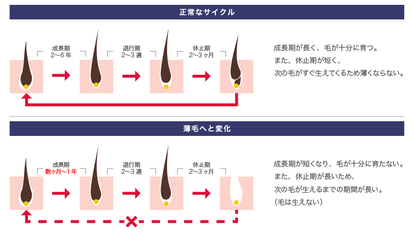 正常なサイクル 成長期が長く、毛が十分に育つ。また、休止期が短く、次の毛がすぐ生えてくるため薄くならない。 薄毛へと変化 成長期が短くなり、毛が十分に育たない。また、休止期が長いため、次の毛が生えるまでの期間が長い。(毛は生えない)