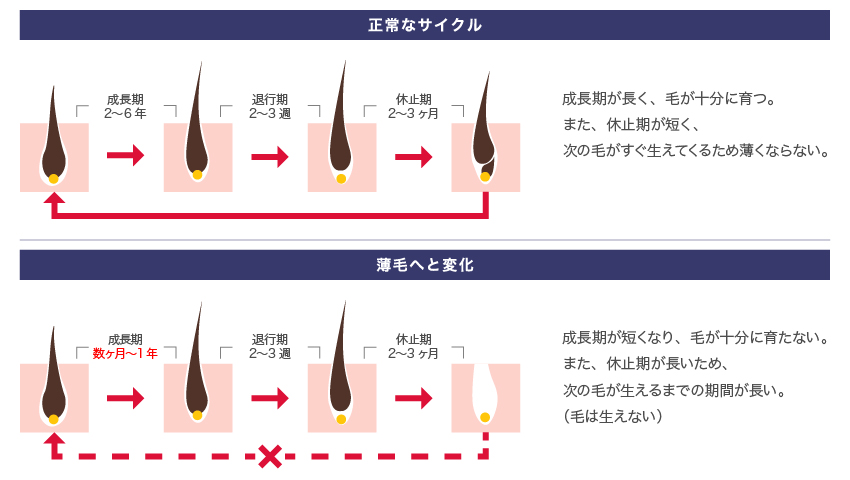 正常なサイクル 成長期が長く、毛が十分に育つ。また、休止期が短く、次の毛がすぐ生えてくるため薄くならない。 薄毛へと変化 成長期が短くなり、毛が十分に育たない。また、休止期が長いため、次の毛が生えるまでの期間が長い。（毛は生えない）