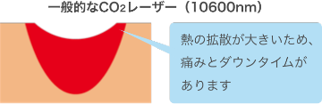 照射時の痛みが少なく、麻酔なしでもOK