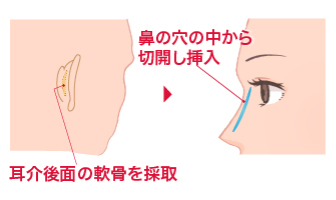 耳介後面の軟骨を採取 鼻の穴の中から切開し挿入

