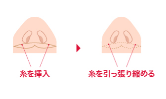 糸を挿入 糸を引っ張り縮める