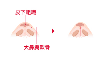 皮下組織 大鼻翼軟骨
