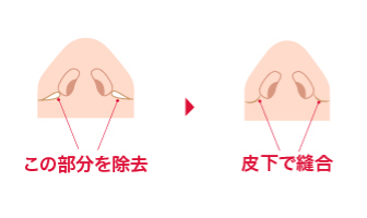 この部分を除去 皮下で縫合