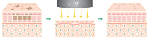 特徴1 最新のレーザーピーリング治療