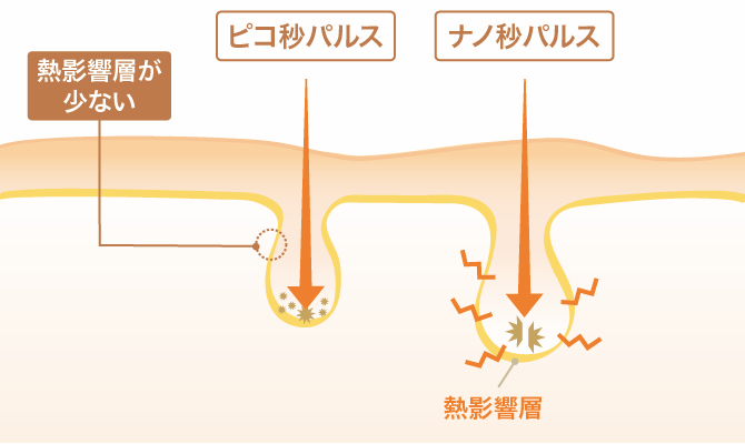 ピコ秒パルスはナノ秒パルスにくらべ熱影響が少ない