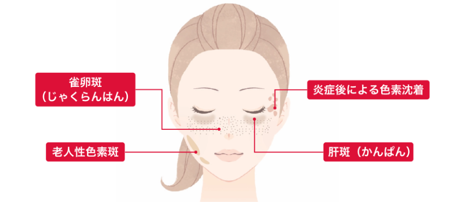 シミ、肝班(かんぱん)の種類