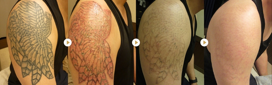 刺青・タトゥー除去の症例