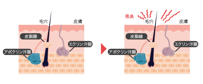 ワキガとは