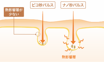 ピコレーザーの特徴2